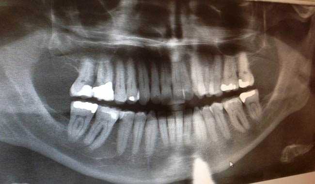 Dentisti, attenzione a non sottoporre i pazienti a troppe radiografie inutili