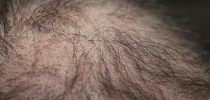 La tricopigmentazione a Roma per eliminare alopecia