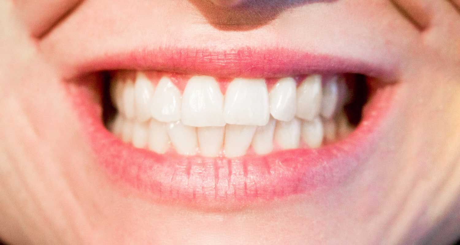 Sul web metodi per sbiancare i denti che possono essere devastanti
