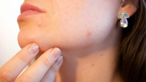 Attenzione acne rosacea come puoi trattarla