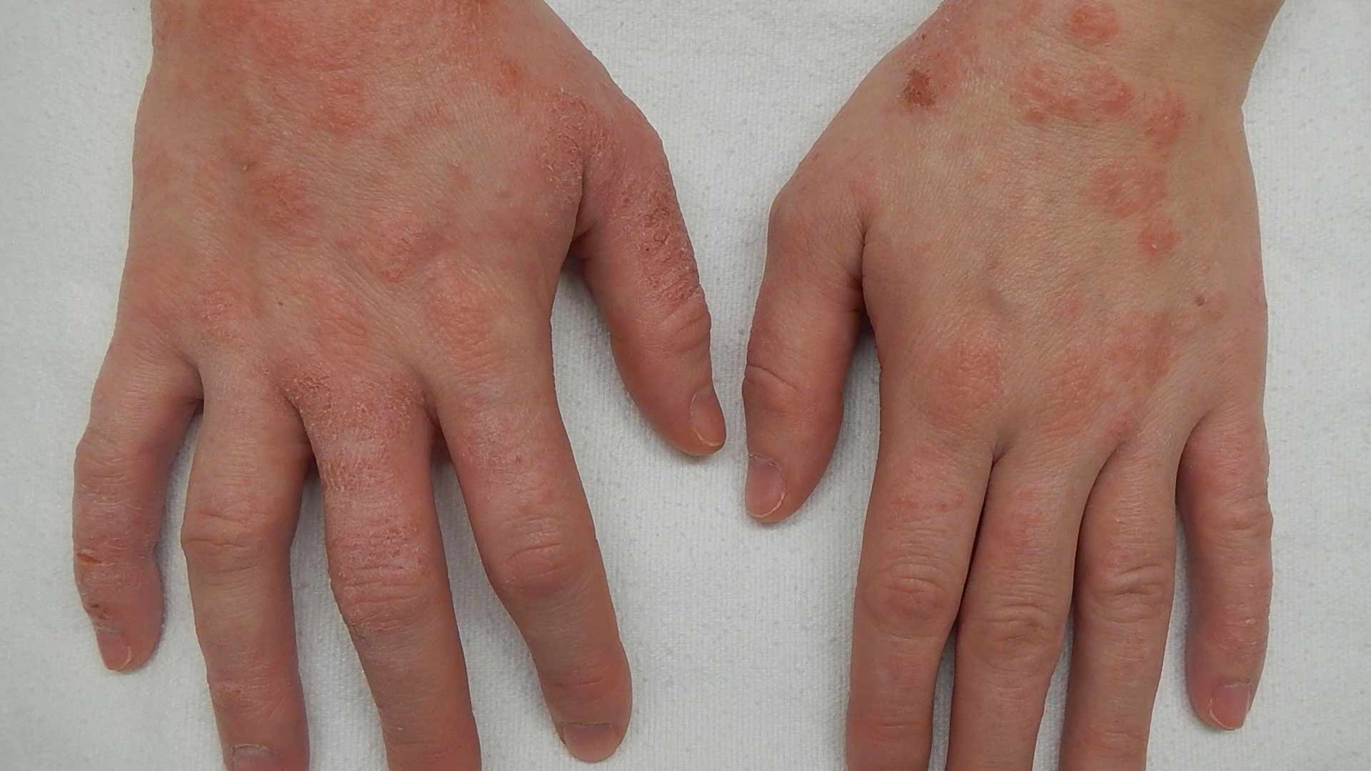Eczema ecco cosa fare per ridurre il prurito