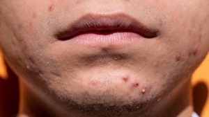 Come curare le cicatrici da acne giovanile