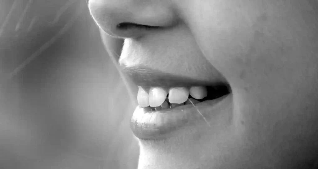 Faccette dentali e gengive quando preoccuparsi