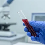 Alzheimer, la svolta che stavamo aspettando: basterà un esame del sangue per scoprirlo anni prima